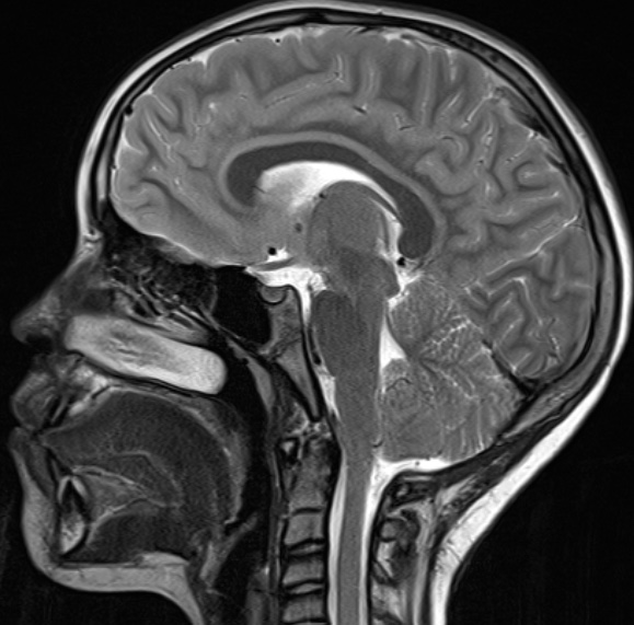 MRI scan, chiari malformation, after surgery. Posterior fossa has been decompressed, allowing for more room for the tonsils.