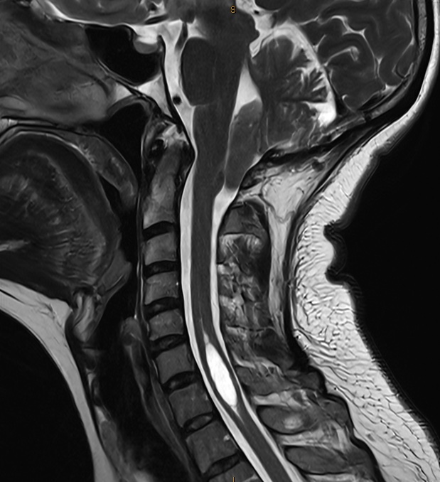 MRI scan, chiari with syringomyelia, before surgery. Cerebellar tonsils have herniated into the spinal canal, impeding the flow of cerebrospinal fluid (CSF). Syrinx in the spinal cord.